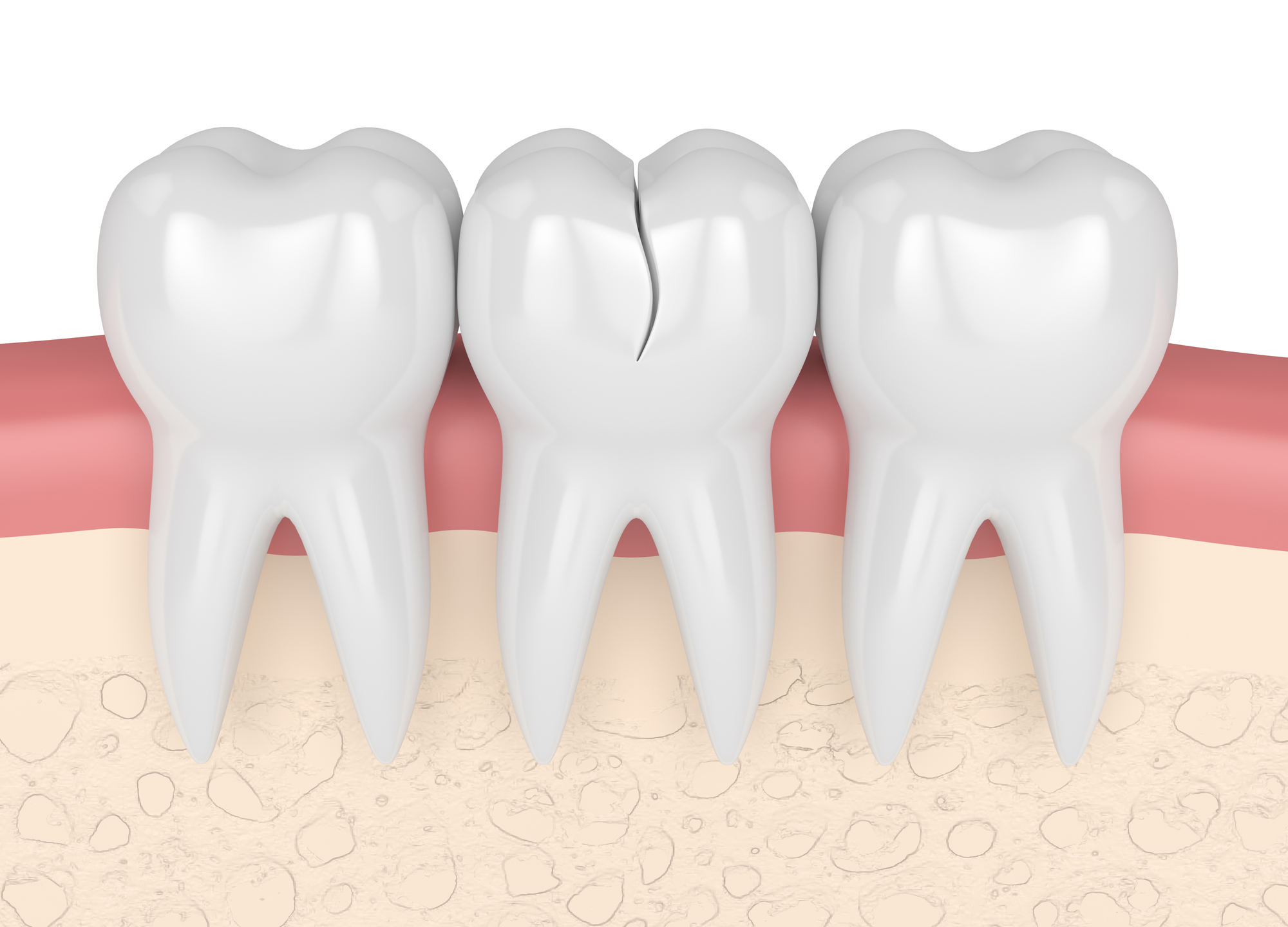 3d render of gums with cracked tooth