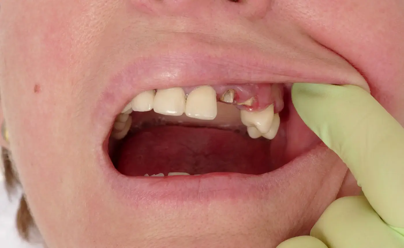 broken_teeth_treatment_in_Denver_CO