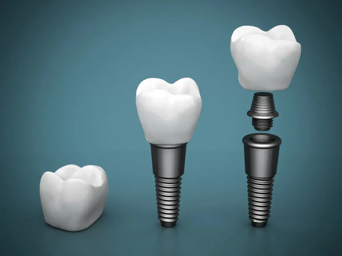 parts of a dental implant